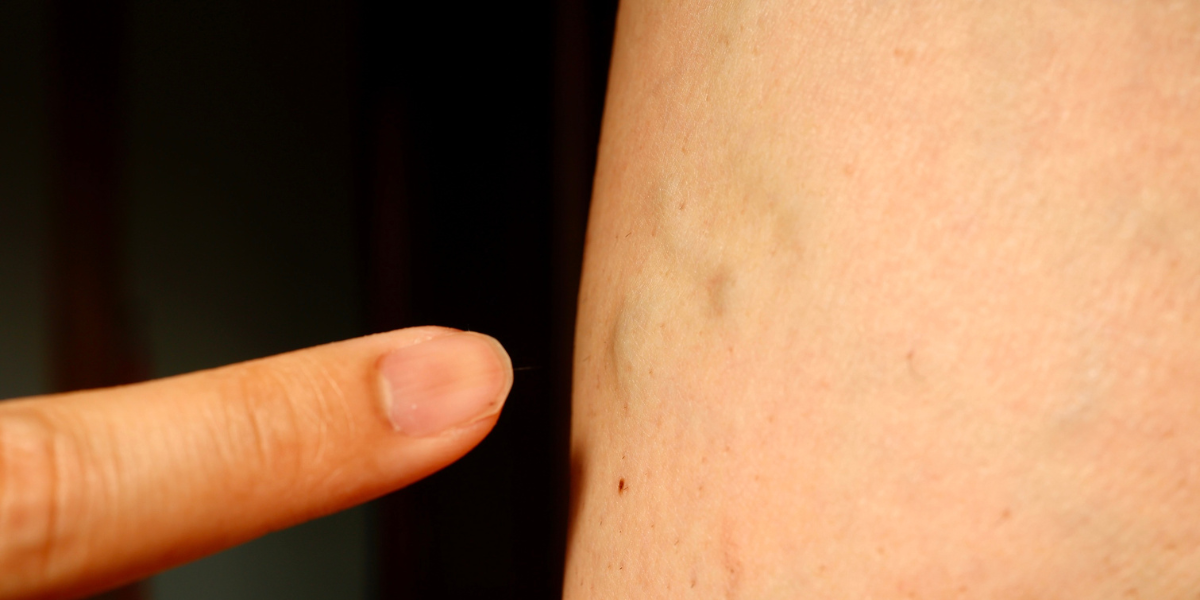 Advanced, Minimally Invasive Treatments For Vein Problems
