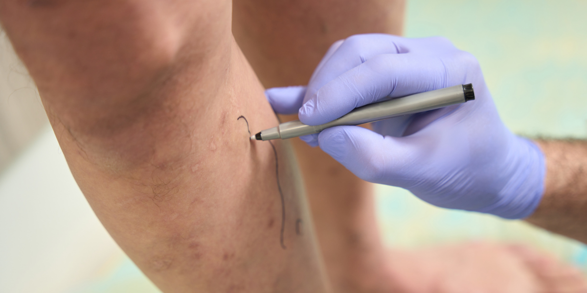 How We Diagnose And Treat Vein Issues At TeamMD Medical
