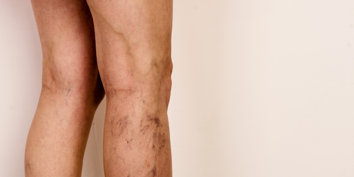 Subtle Lifestyle Triggers That Still Impact Vein Health