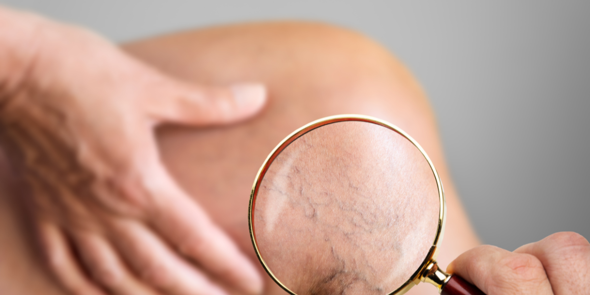 When To Seek Professional Care For Vein Issues

