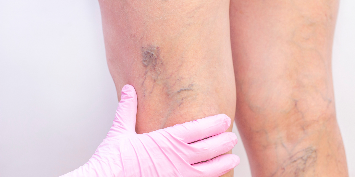 Why Do Some People Develop Vein Issues Even Without Risk Factors?