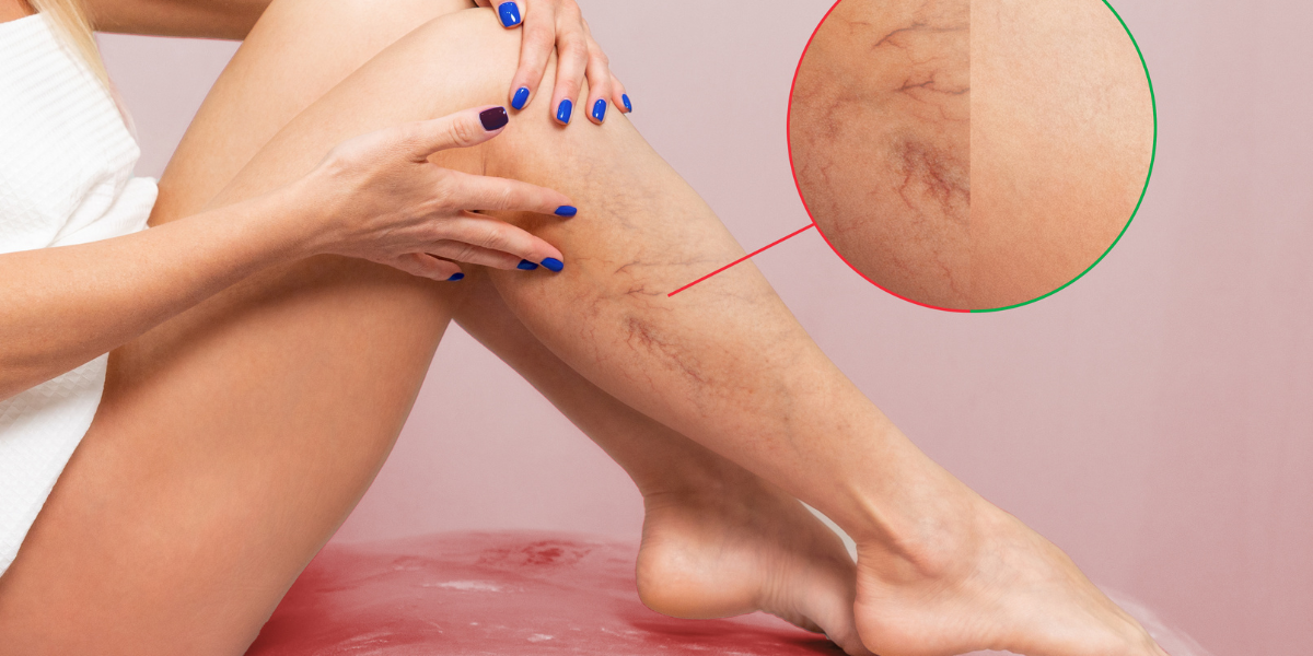 How Varicose Veins Can Overlap With Other Pain and Mobility Conditions
