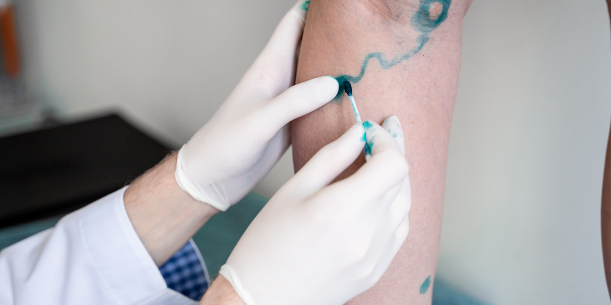 How Vein Specialists Diagnose Varicose Veins
