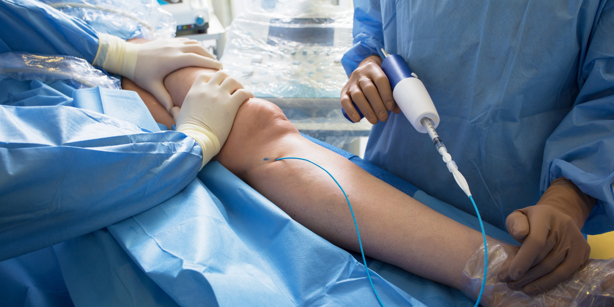 Minimally Invasive Vein Treatments for Lasting Relief

