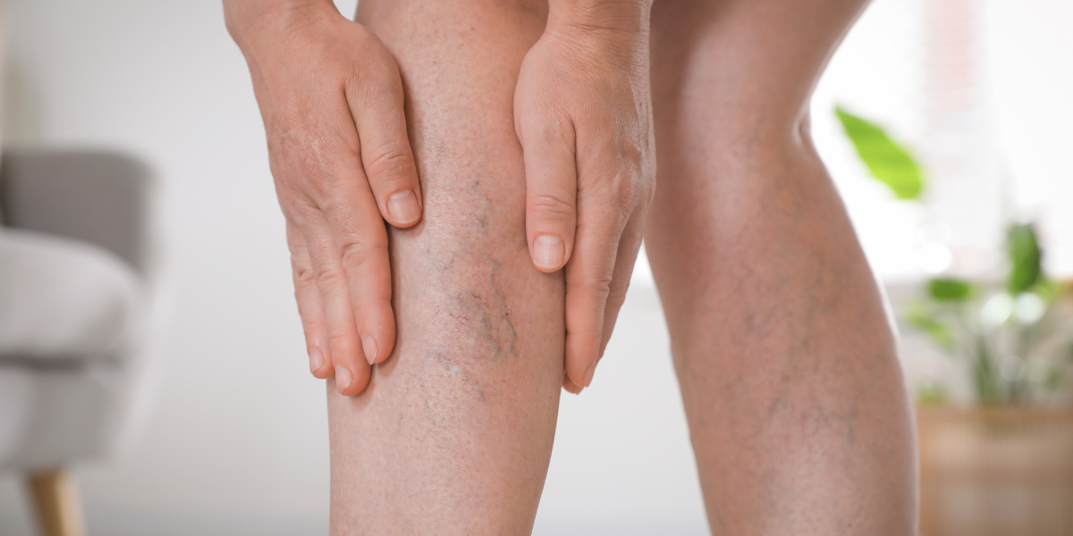 Symptoms That May Indicate You Need Vein Treatment