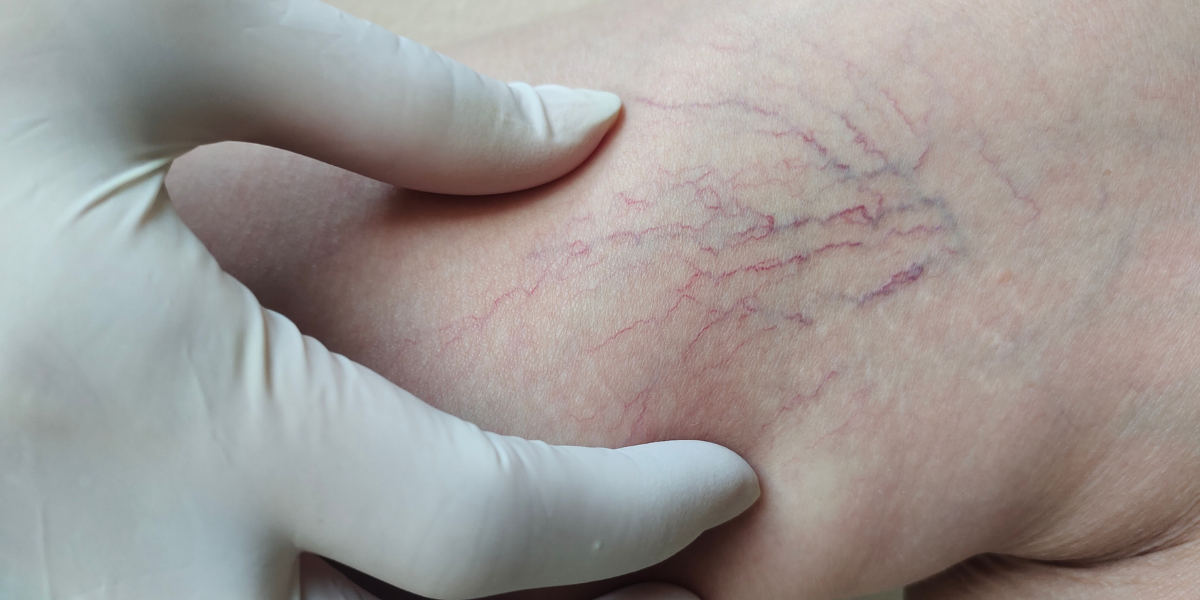 Understanding Varicose Veins and Why They Develop
