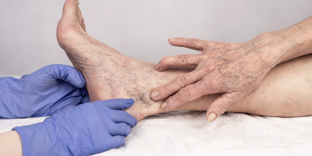 When Should You See a Doctor for Varicose Veins? A Vein Treatment Guide